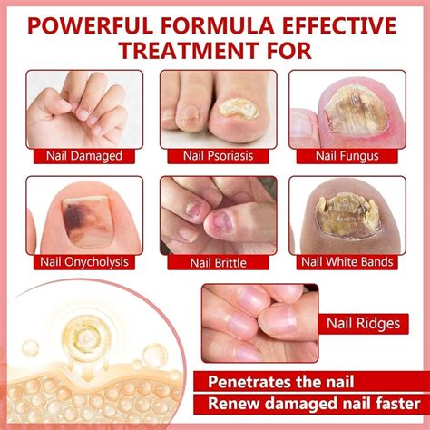 Chamex Toenail Fungus Treatment Extra Strength, Nail Fungus India | Ubuy