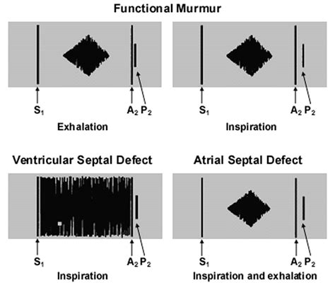 Still's murmur definition, Still's murmur description & diagnosis