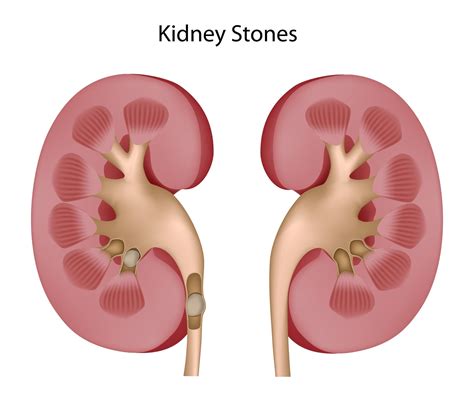 Kidney Stones Causes and Treatment Schemes | Doctor Tipster
