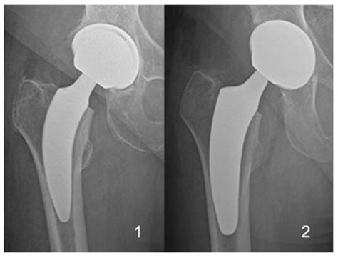 Does the Implantation of a Short-Stem Hip Prosthesis Change the Lower ...