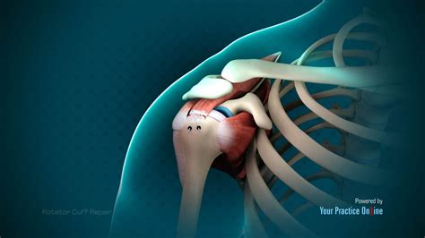 Image result for Rotator Cuff Repair Photo