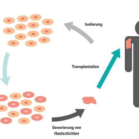 Gentherapeutische Ansätze für die Epidermolysis bullosa - Dermatologie ...