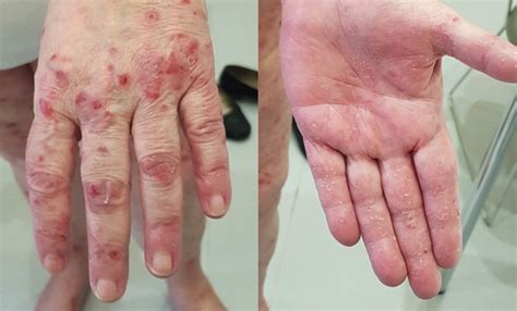 Eine Diagnose auf der anderen - Dermatologie - Universimed - Medizin im ...