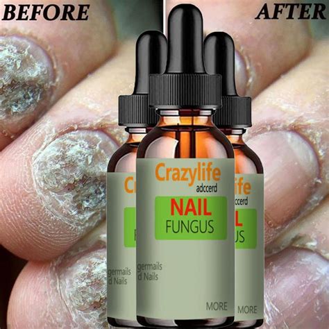 Hand and Foot Nail Onycho Repair Nail Onychomycetant for Thickening ...