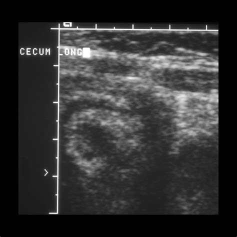 Pediatric Infectious Colitis | Pediatric Radiology Reference Article | Pediatric Imaging ...
