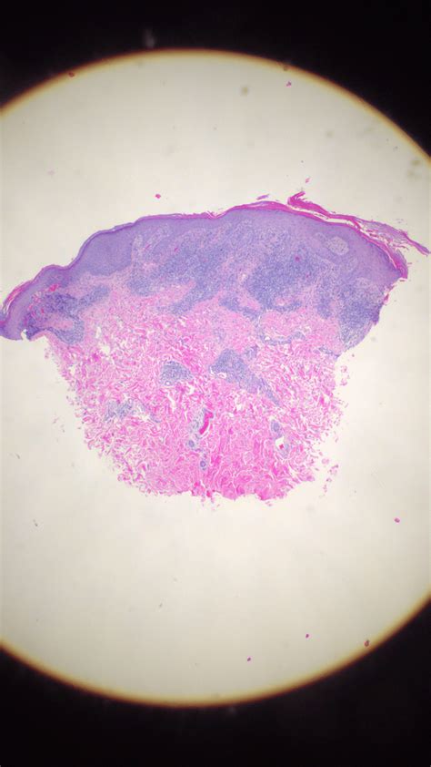 Fixed Pigmented Erythema