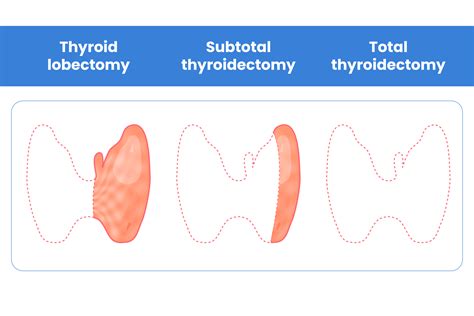 Understanding the Different Types of Thyroidectomy