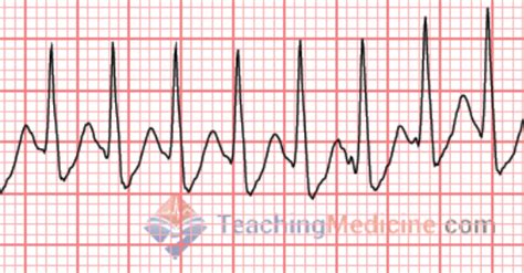 Image result for Pacemaker Programming