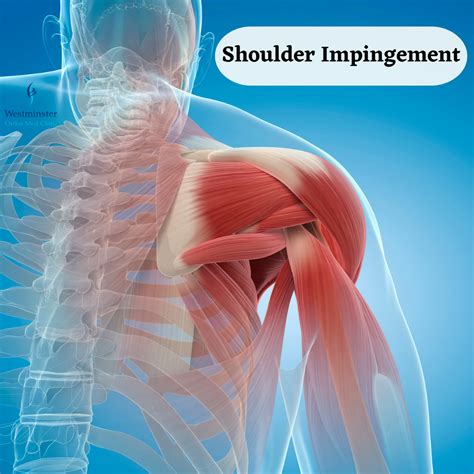 Shoulder Impingement Treatments