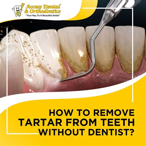 How To Remove Dental Black Plaque at Jeannie Wilson blog
