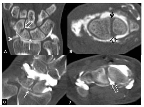 SLAC and SNAC Wrist: The Top Five Things That General Radiologists Need ...