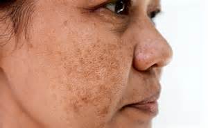 Skin Pigmentation: क्यों होती है चेहरे पर झाइयां? यहां जानिए समय रहते ...