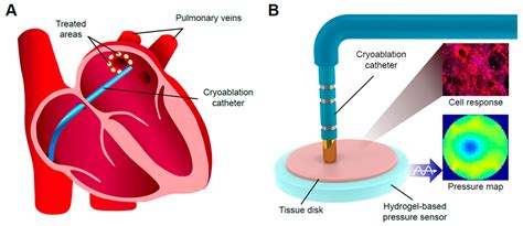 Heart Catheter Ablation at Ryder Sidaway blog