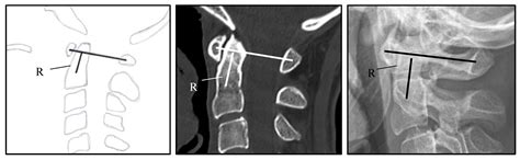 Cervical Myelopathy in Patients Suffering from Rheumatoid Arthritis—A ...