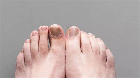 Home Remedies For Paronychia,കാലിലെ കുഴിനഖത്തിന് വീട്ടിലുണ്ട് പരിഹാരം ...