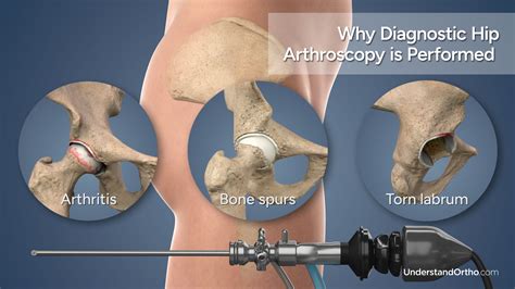Arthritis And Bone Spurs In Hip at Lucy Hynes blog