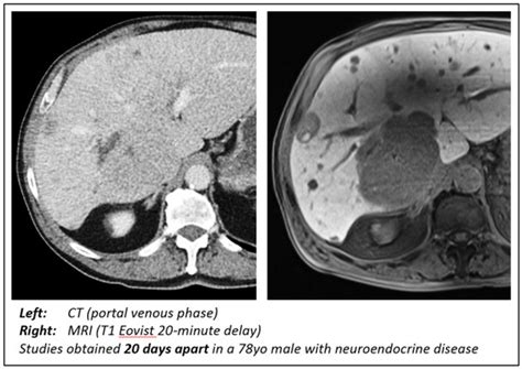 Defining MRI Superiority over CT for Colorectal and Neuroendocrine ...