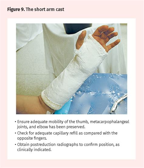 Short arm cast | The College of Family Physicians of Canada