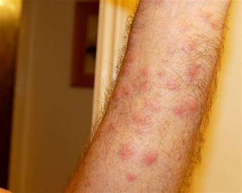 Image result for Moth Rash