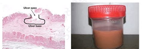 Entamoeba Histolytica - Medical Science Optional Notes for UPSC PDF ...