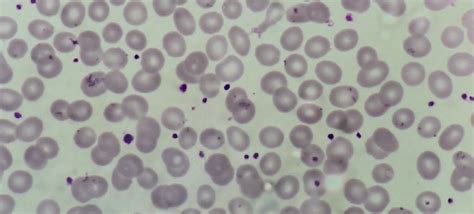 Essential Thrombocythemia - howitreat.in