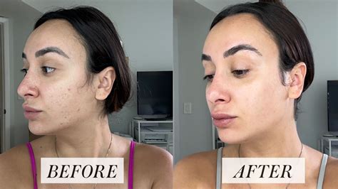 Retin A Before And After Acne