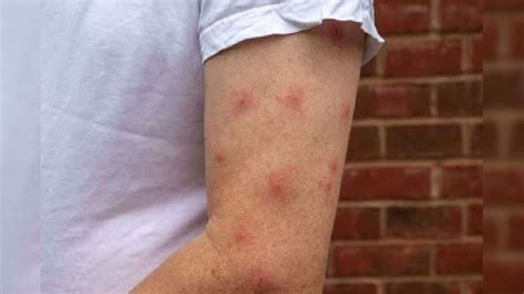 Relief From Insect Bite: వర్షాకాలంలో పురుగు కరిచిందా ? ఈ 5 చిట్కాలు ...