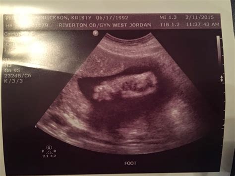 Normal amniotic fluid - eyfreeloads