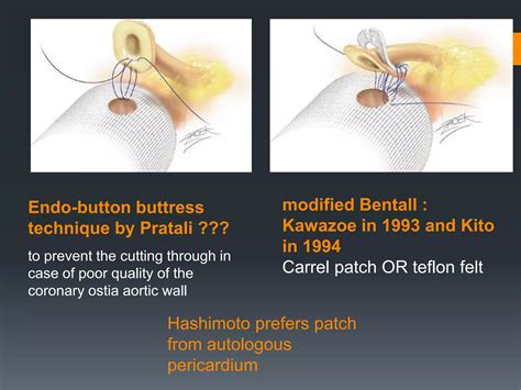 Aortic root surgery. Bentall operation | PPTX