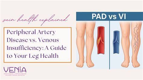 Peripheral Artery Disease vs Venous Insufficiency | Venia MD in CDA