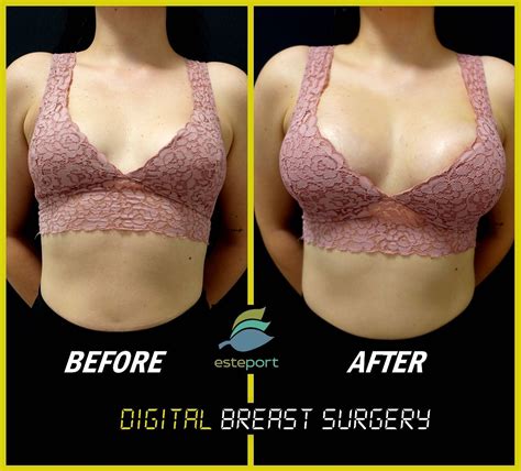 Uneven Breasts Surgery Before And After