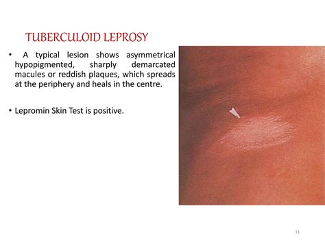 leprosysyphilis - LEPROSY & SYPHILIS.pptx