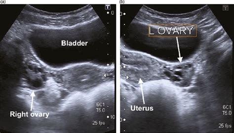 Pelvic Exam Vs Ultrasound at Angela Bates blog