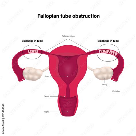 Image result for Cut Off Fallopian Tube
