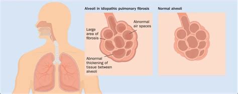 Pulmonary fibrosis - Understanding idiopathic scarring of the lungs