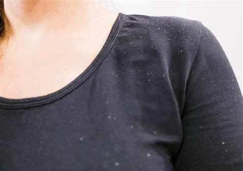 What Is Causing Dandruff & How Is It Affecting Your Hair Health | Femina.in