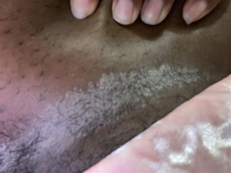 What is this Rash under stomach : r/DermatologyQuestions