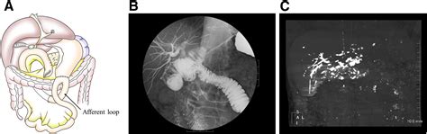 A Rare Complication of Barium Swallow Test - Gastroenterology