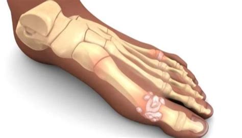 High Uric Acid Problem-Hyperuricemia – Nutrisage India