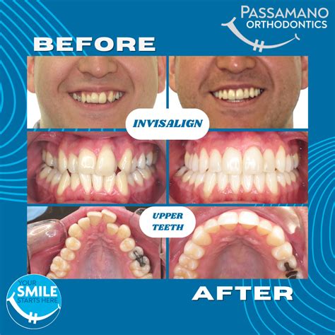 Expansion Invisalign Adult Male - Passamano Orthodontics