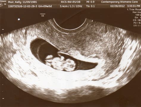 Ultrasound Pictures Week By Week