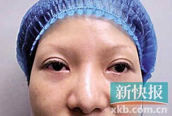 女子3千割眼袋3个月眼睛闭不合 的图像结果