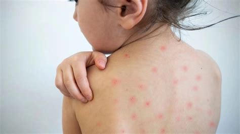 Indore: Four new measles cases, total reaches 53