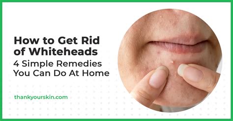 How to Get Rid of Whiteheads: 4 Simple Remedies You Can Do At Home