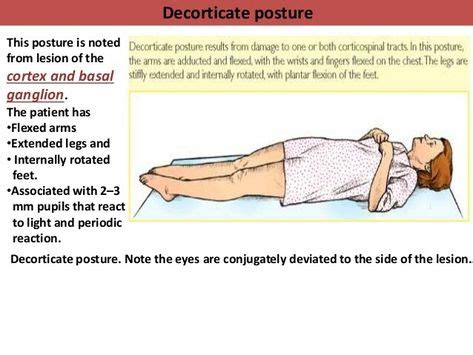 Image result for Decorticate Posture