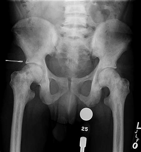 Considerations in the Sickle Cell Patient Undergoing Hip Reconstructive Surgery - Orthopedic Clinics