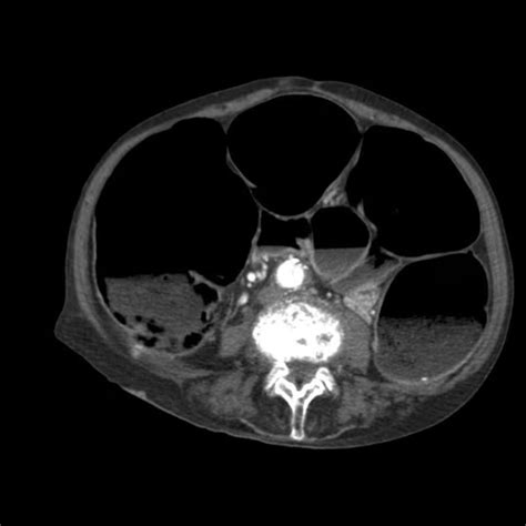 Ogilvie’s Syndrome Post-Cesarean: Recognizing a Silent Surgical Threat