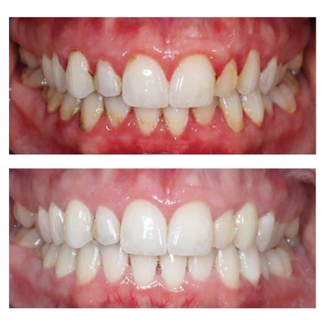 How Long Should You Brush Your Teeth For? Expert Advice from a Leading Periodontist in London ...