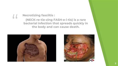 Necrotizing Fasciitis : “Life After Flesh-Eating Bacteria” by Antra ...