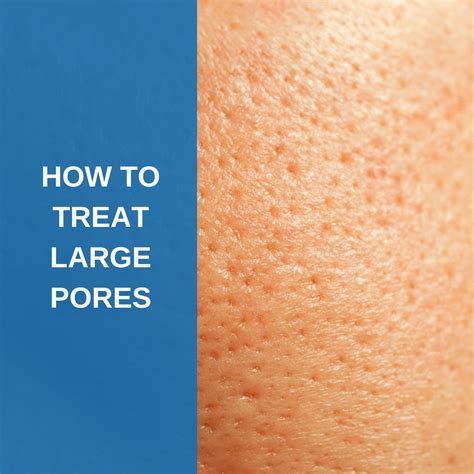 How To Treat Large Pores - Savannah River Dermatology